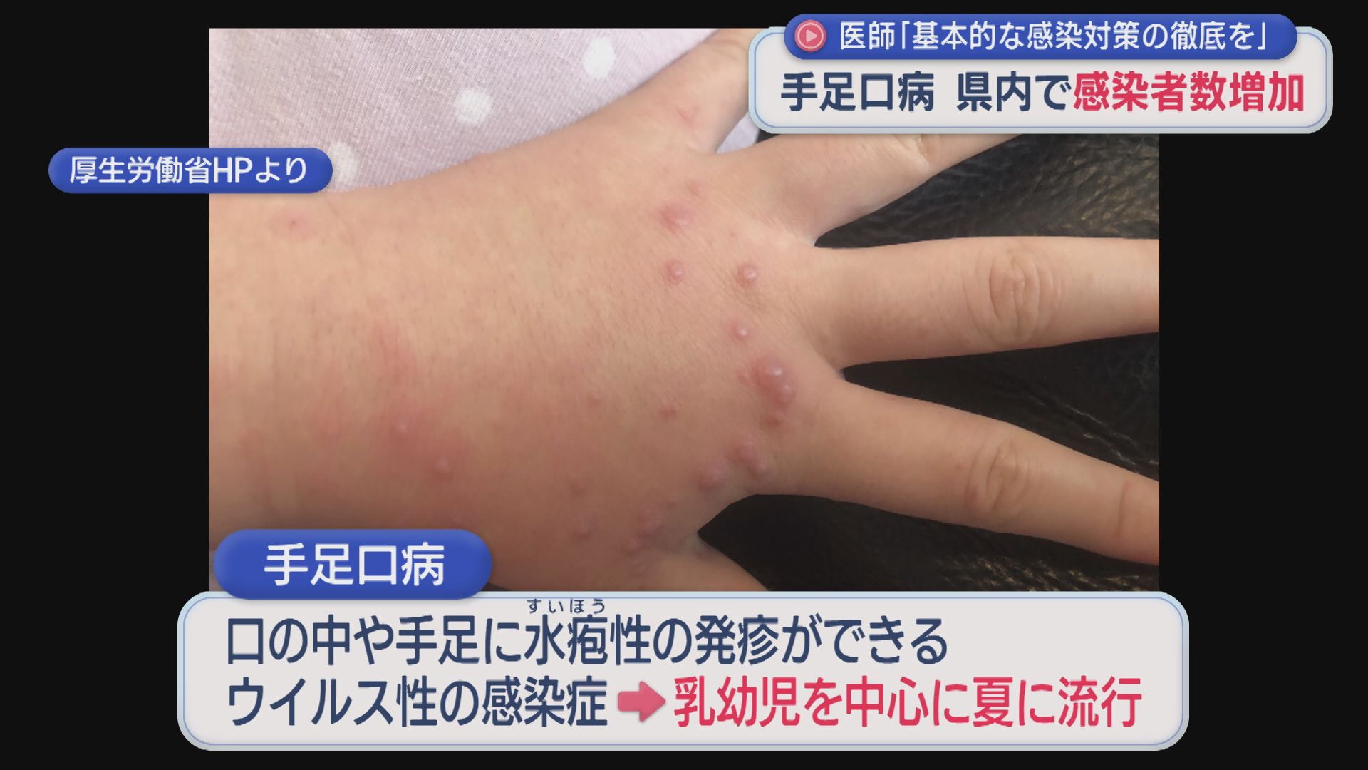 県内でも感染者数増加「手足口病」前週に比べて2.4倍に増加【新潟】 2026年07月13日(月)